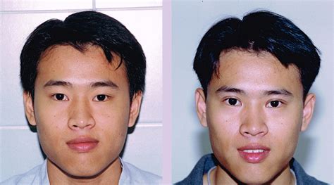 dr chettawut sex reassignment and facial feminization surgery center upper eyelid double