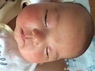 新生兒濕疹治療方法 - 每日頭條