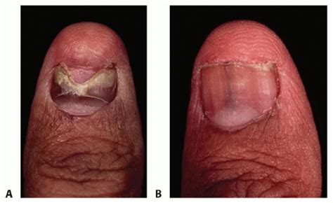 Nail Matrix Repair Reconstruction And Ablation Musculoskeletal Key