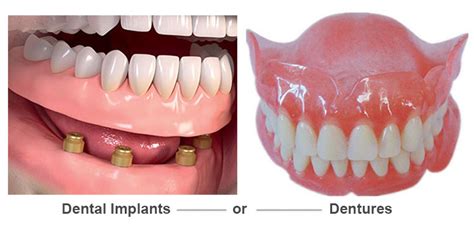 Dentures Vs Implants Pros And Cons Dental News Network