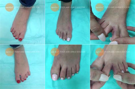 Webbed Toe Seperation Surgery Syndactyly Surgery Joined Toes