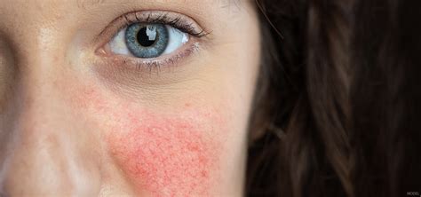 The Facts About Rosacea Boise Dermatology And Medspa