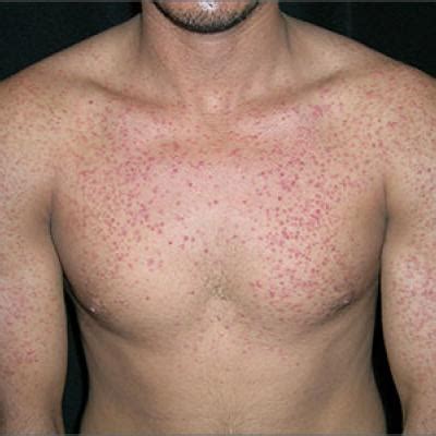 Pruritic Rash On Chest MDedge Family Medicine