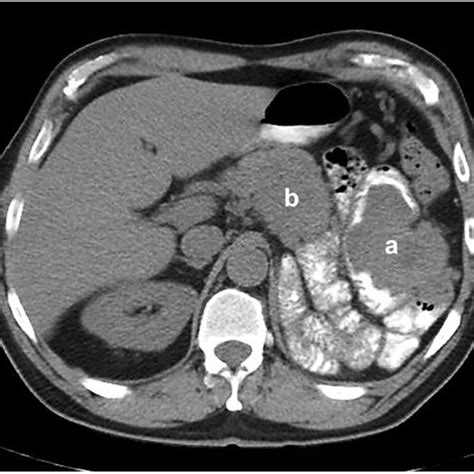 Axial View Of The Abdominal Ct With Oral Contrast Showing The Left