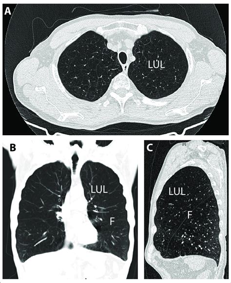 An Example Of A High Resolution Computed Tomography Scan Of The Lung