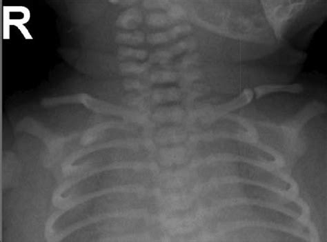 Chest X Ray Showing Left Sided Clavicular Fracture Case Courtesy Of