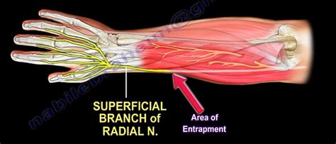 Wartenbergs Syndrome The Superficial Branch Of The Radial By Nabil