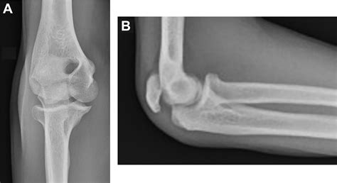 Olecranon Avulsion Fracture