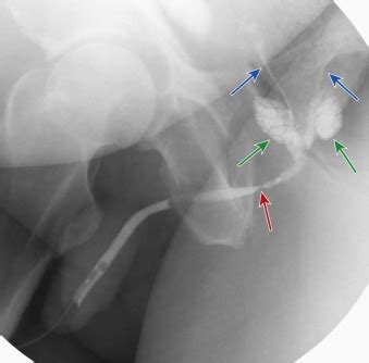 Imaging Of Disorders Of The Male Urethra Radiology Key