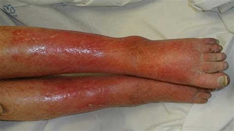 Are You Suffering From Cellulitis Podiatry HQ