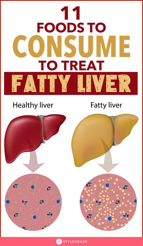 pin on fatty liver