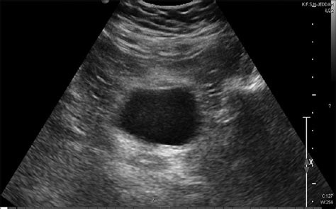 Normal Pelvic Ultrasound