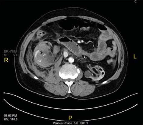 Abdominal Contrast Enhanced Computed Tomography Scan Showing