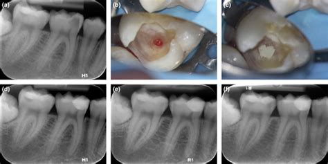 Management Of Deep Caries And The Exposed Pulp Bjørndal 2019