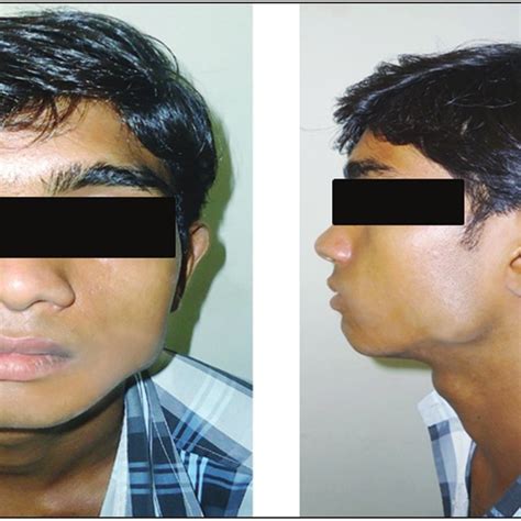 Front And Side Profile Photograph Of The Patient Showing Extraoral