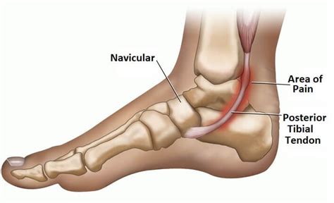 Posterior Tibial Tendonitis Foot Pain Explored The Best Porn