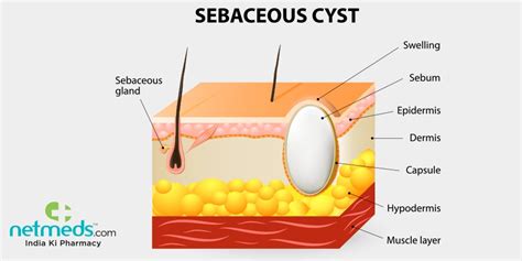 How To Prevent Sebaceous Cysts Sonmixture11