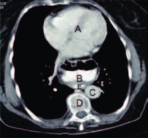 Axial Ct Scan Thorax With Oral Contrast Demonstrating Herniation Of