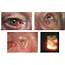 Nodular Basal Cell Carcinoma  American Academy Of Ophthalmology