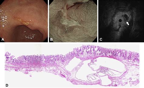 Early Gastric Cancer On Submucosal Heterotopic Gastric Glands