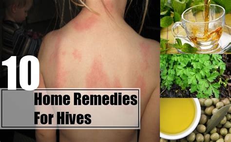 Home Remedies For Hives Home Remedies For Hives Hives Remedies Home
