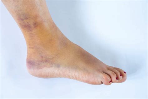 Bruised Ankle Stock Photos Pictures And Royalty Free Images Istock