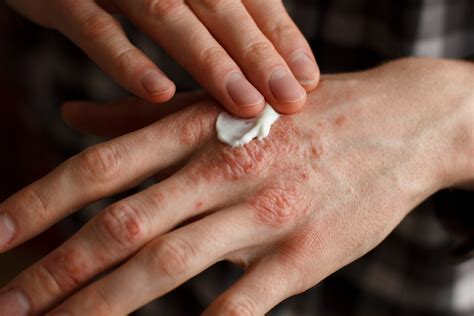 Psoriasis Treatment From A Dermatologist Dermatology Associates Of