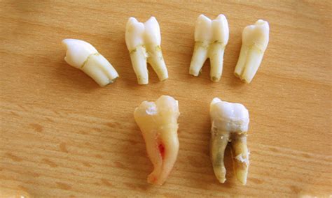 Myths And Facts About Wisdom Teeth Removal 2022 Updated