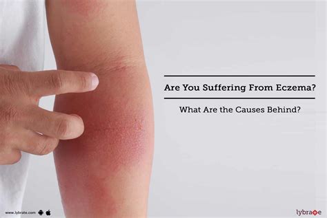 Are You Suffering From Eczema What Are The Causes Behind It By Dr