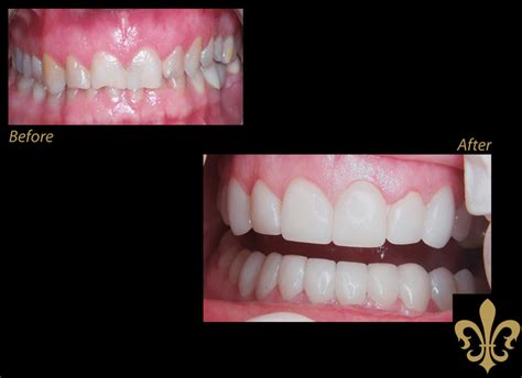 Renaissance dental is a leader in the dental insurance industry. See some of our before and after images of REAL patients!