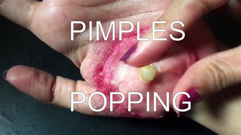 Pimples Popping Compilation 2017 Youtube
