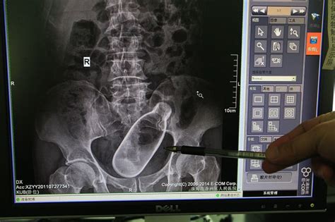 Shocking Hospital X Ray Shows Man With Bottle Stuck Inside Him Mirror