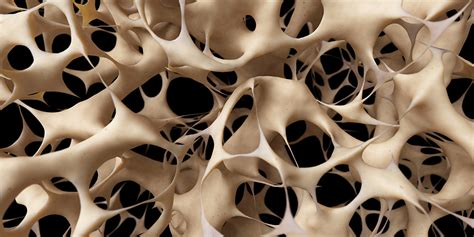 From wikimedia commons, the free media repository. Learn What Osteoporosis Is and What It's Caused by