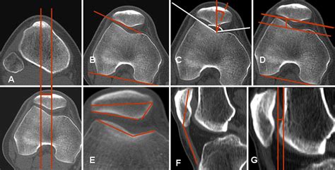 Patellofemoral Morphometry In Patients With Idiopathic Patellofemoral