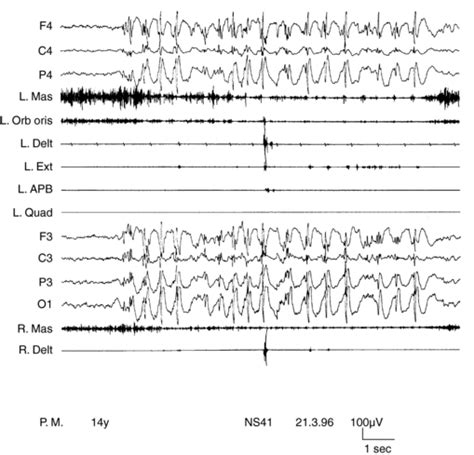 Cortical Myoclonus And Epilepsy Overlap And Differences Neupsy Key