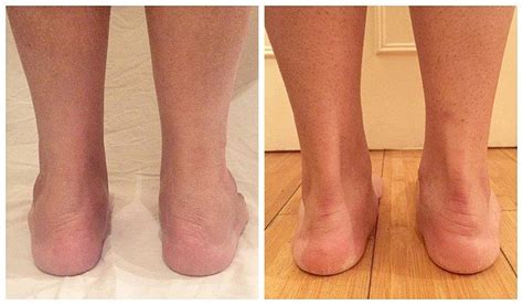 Yes You Can Get Rid Of Cankles Slim Legs Workout Ankle Exercises Calf Exercises