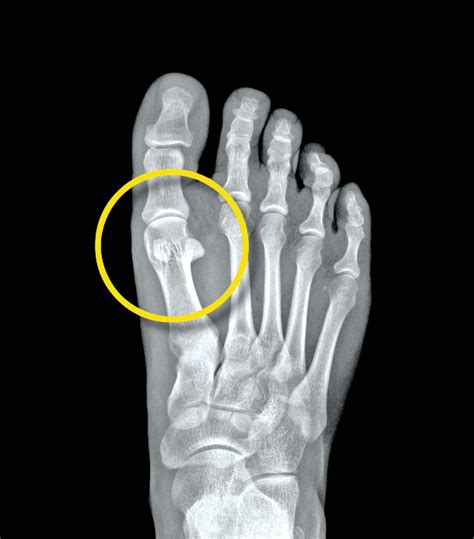 Dr Yoshidas Foot Orthotic Center Sesamoid Foot Pain Orthotic