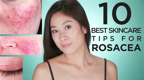 10 Best Skin Care Tips For Rosacea Vivienne Fung Youtube