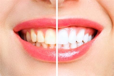 Premium Photo Teeth Before And After Whitening