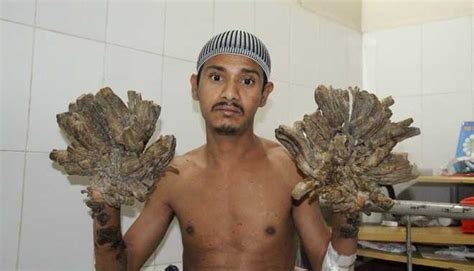Tree Man Back In Hospital After Rare Condition That Turns His Hands