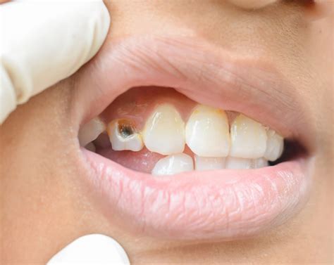 What To Do When Front Tooth Cracked Springvale Dental Clinic