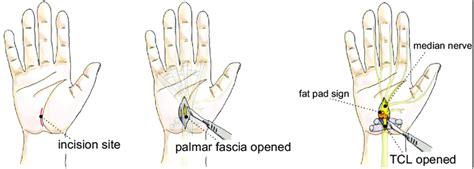 Carpal Tunnel Syndrome Release Open Approach Orthopedics Notes