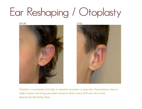 Otoplasty Drake And Presti Ent Surgical Associates