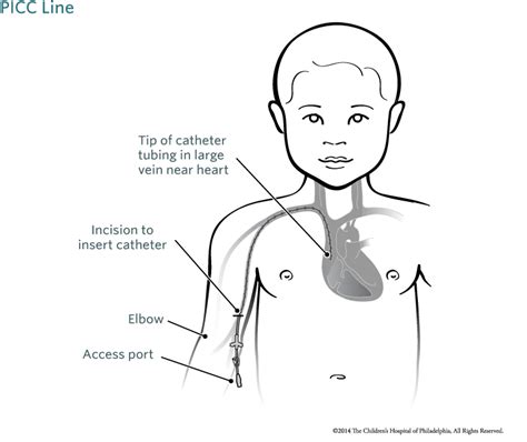 Using A Picc Line Peripherally Inserted Central Catheter