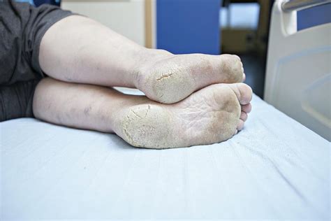 Dry Cracking Feet Ubicaciondepersonascdmxgobmx