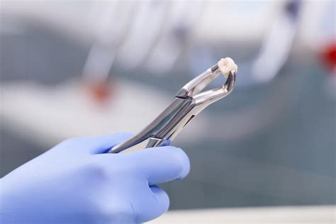 Tooth Extraction Expectations Complications Cost And Aftercare