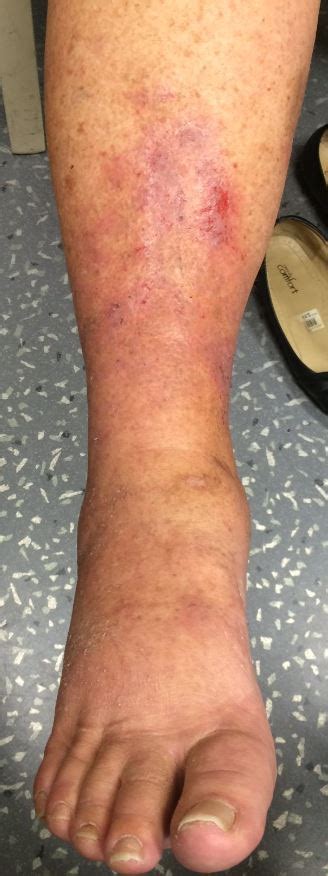 Is It Cellulitis The Case Of Itchy Red Legs Aimed Lets Talk About