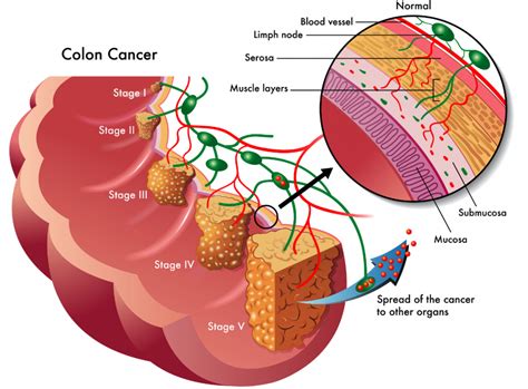 Itw First Ever Colorectal Cancer Blood Test Approved In Us