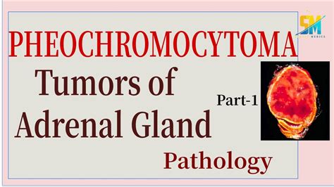 Pheochromocytoma Tumors Of Adrenal Gland Part 1 Pathology