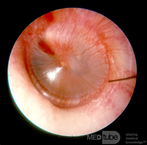 Early Acute Otitis Media Stage Of Redness • Picture •